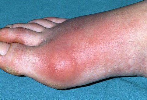 Peradangan dan kemerahan akibat arthritis gout akut pada jempol kaki. 